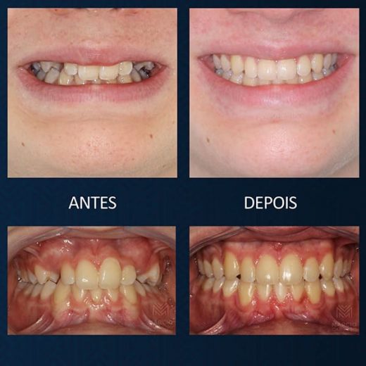 Invisalign. 
Aparelho Invisível.  Aparelho Transparente.