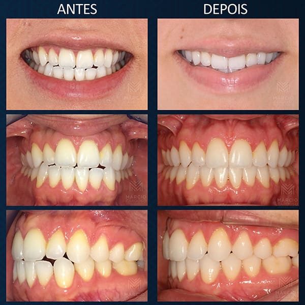 Invisalign. 
Aparelho Invisível.  Aparelho Transparente.