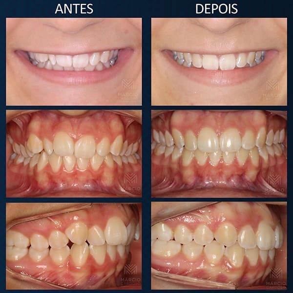 Invisalign. 
Aparelho Invisível.  Aparelho Transparente.